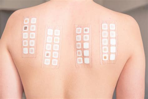 scratch test hives|contact dermatitis patch test.